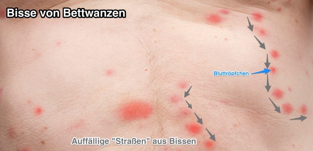 So können Sie Bisse von Bettwanzen erkennen